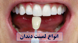 انواع لمینت دندان