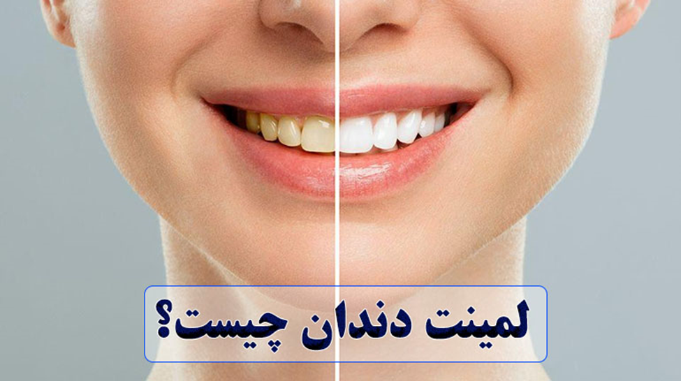 لمینت دندان چیست؟!