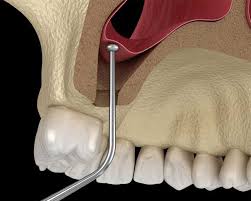 آیا لیفت سینوس همیشه به جراحی وسیع نیاز دارد؟ مجله بدونیم 1