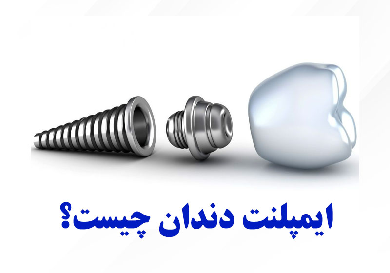 ایمپلنت دندان چیست؟
