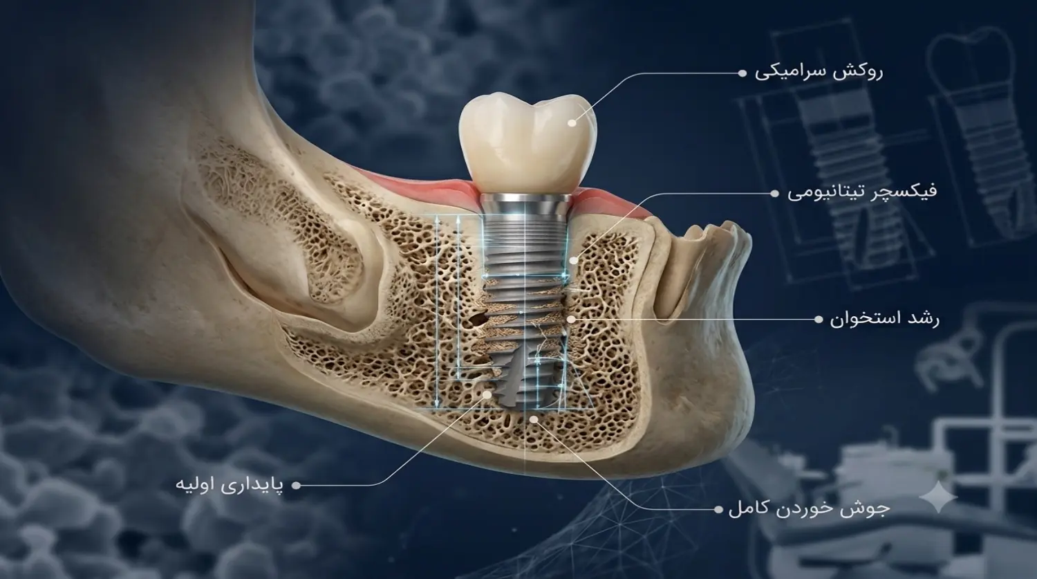 implant bego.3